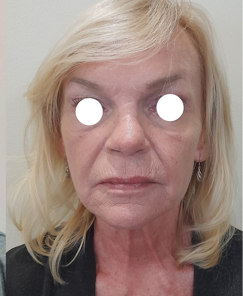 After image